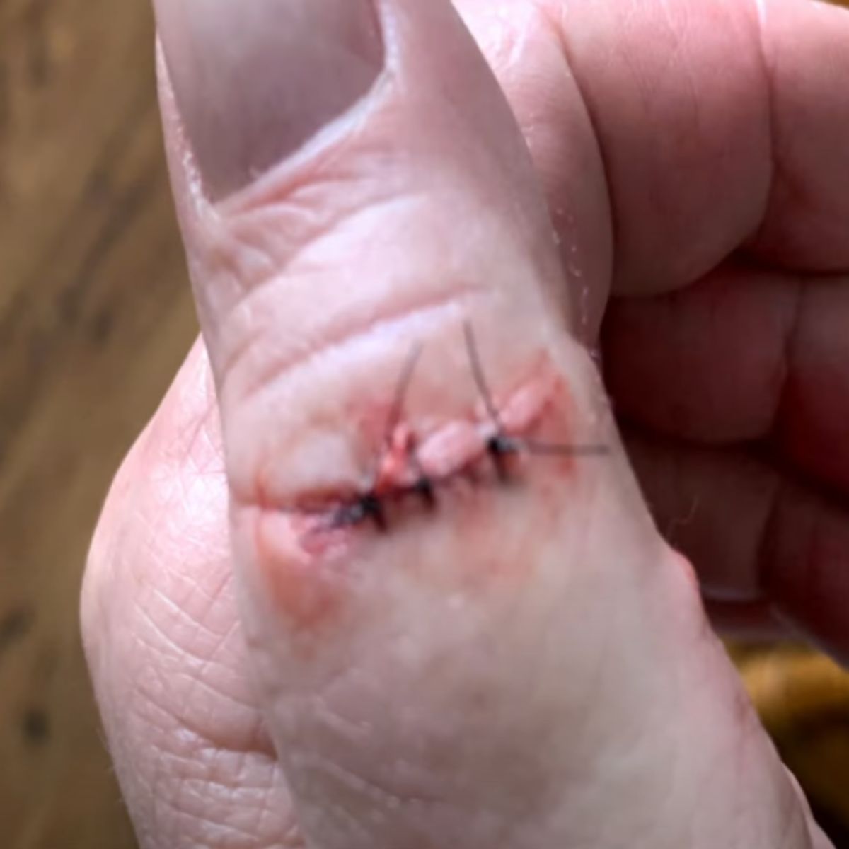 finger with stitches